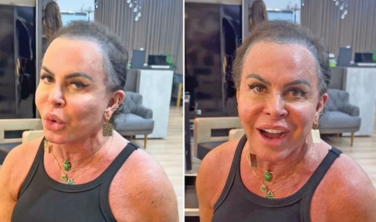 Gretchen surge sem prótese capilar Em tratamento de alopecia
